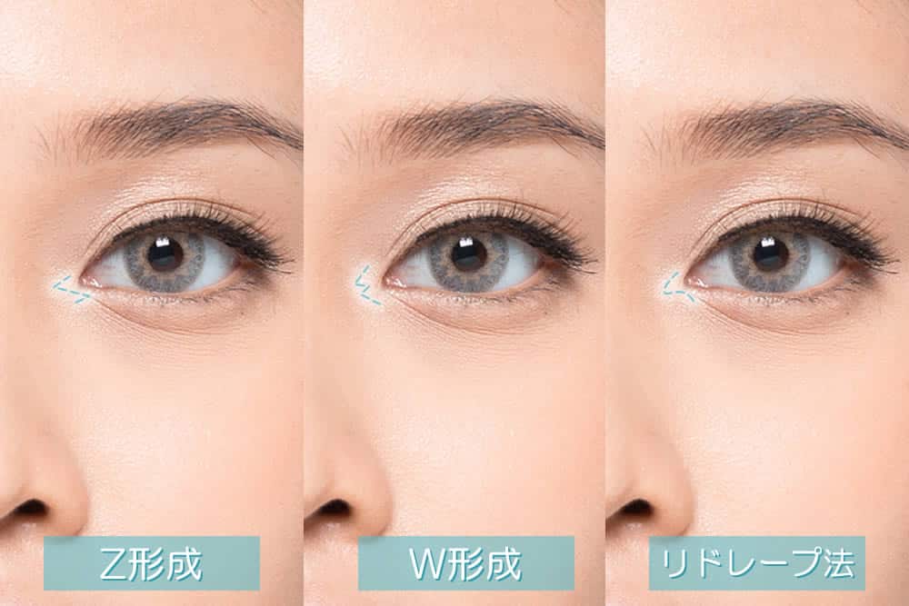 目頭切開の種類