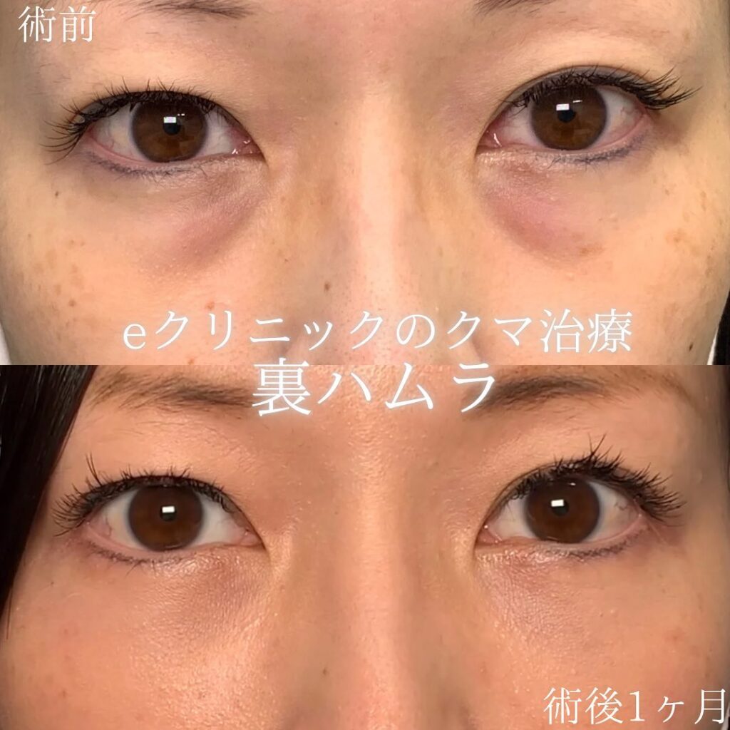 eクリニック岡山院の裏ハムラの症例画像(3)