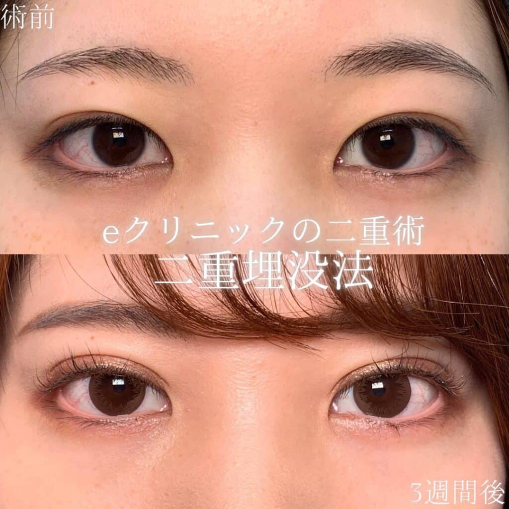 eclinic岡山院の二重埋没法