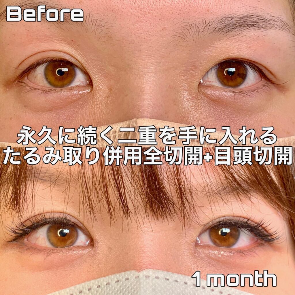 たるみ取り併用全切開と目頭切開の症例写真