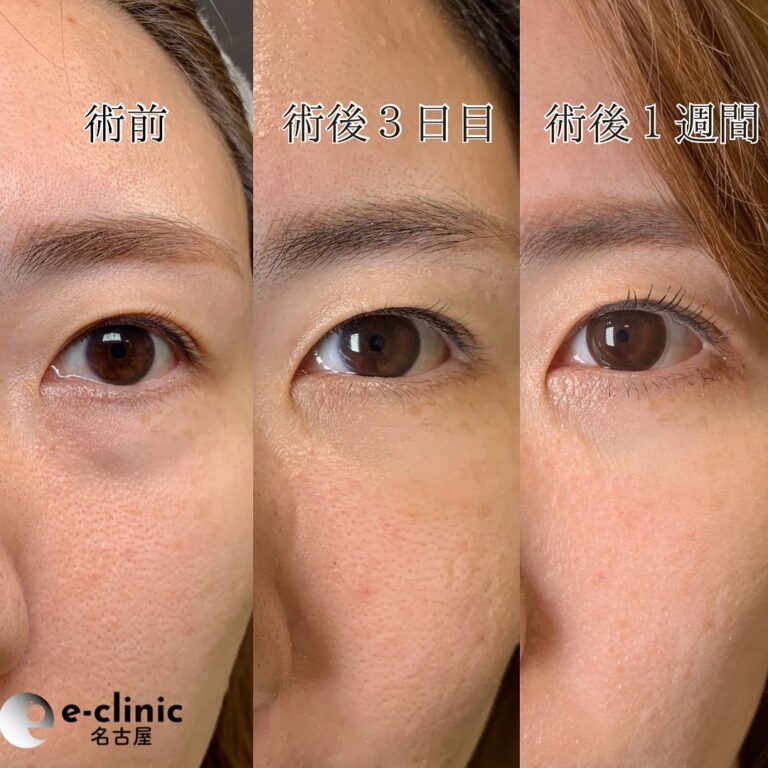 eクリニック岡山院の目の下の脂肪取り(脱脂)とヒアルロン酸注入の3日後と1週間後の症例写真(6)