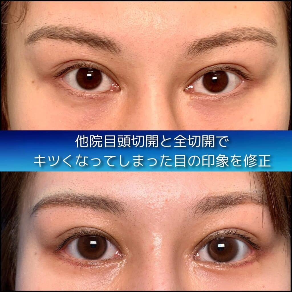 eclinic岡山院の全切開二重術+目頭切開(他院修正)