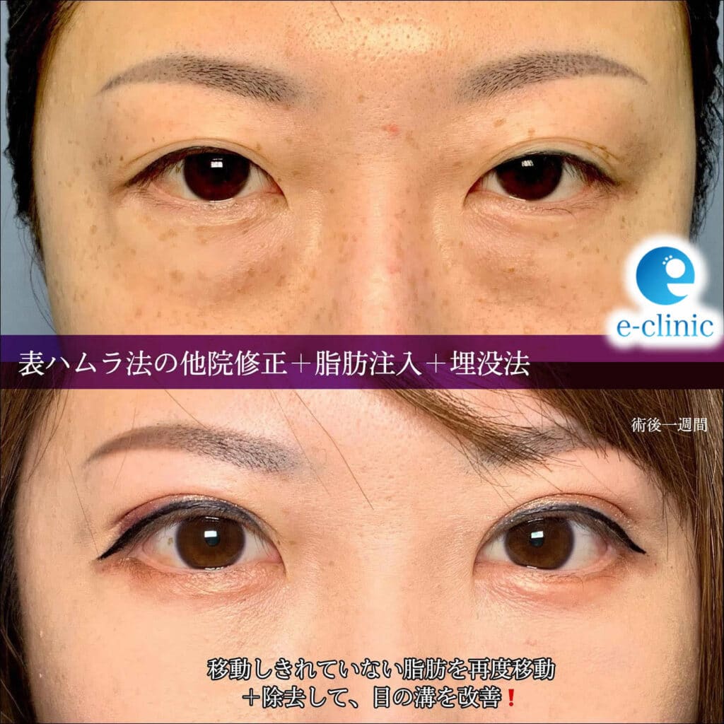 表ハムラの他院修正の症例写真