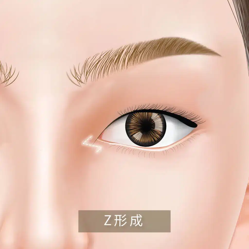 目頭切開切開_z形成