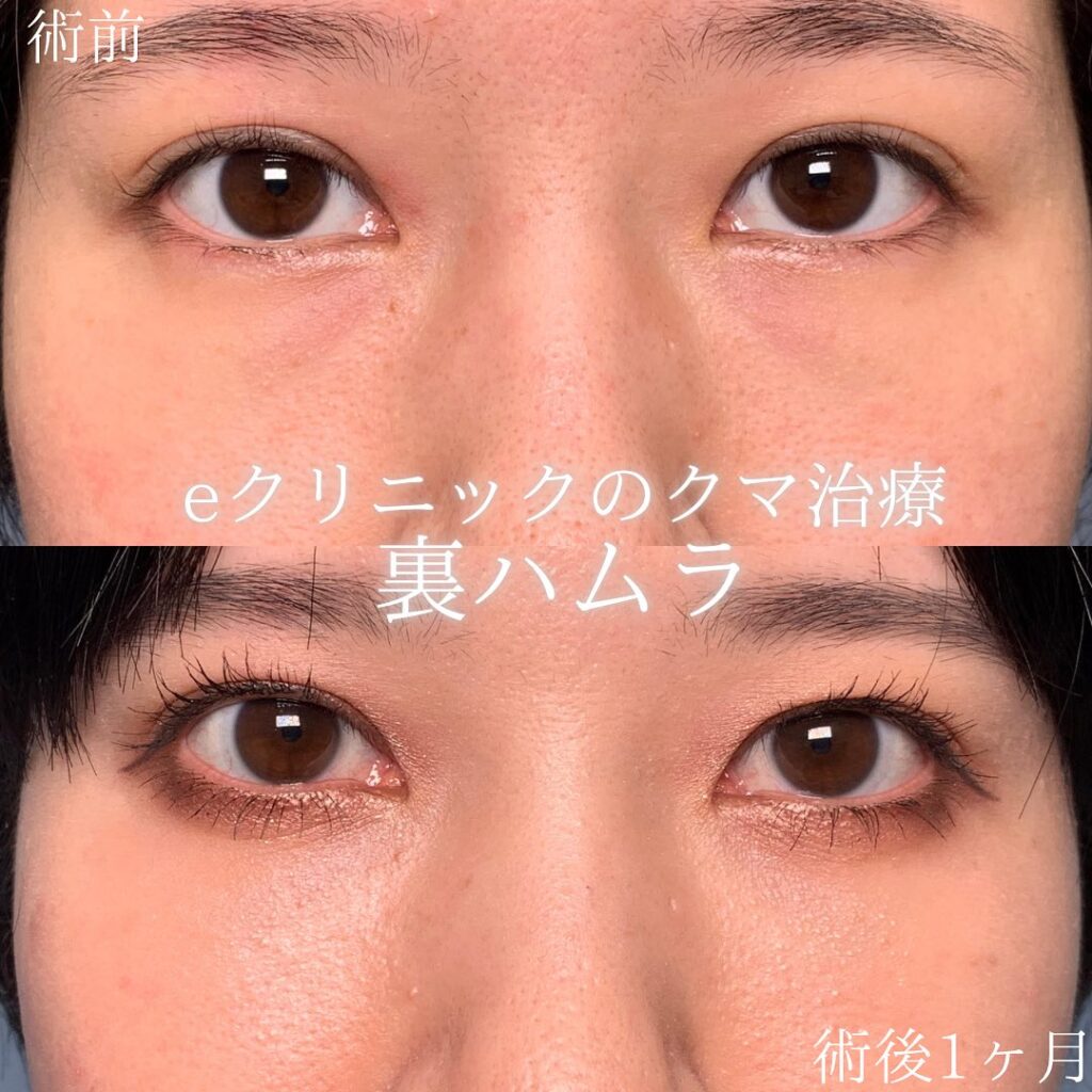 eクリニック岡山院の裏ハムラの症例画像(2)