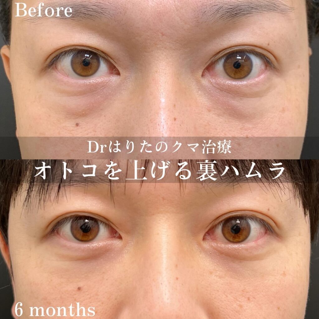 クマ取り_裏ハムラの症例写真(男性)