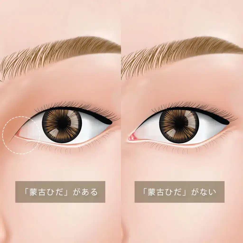 蒙古襞の説明をしている画像