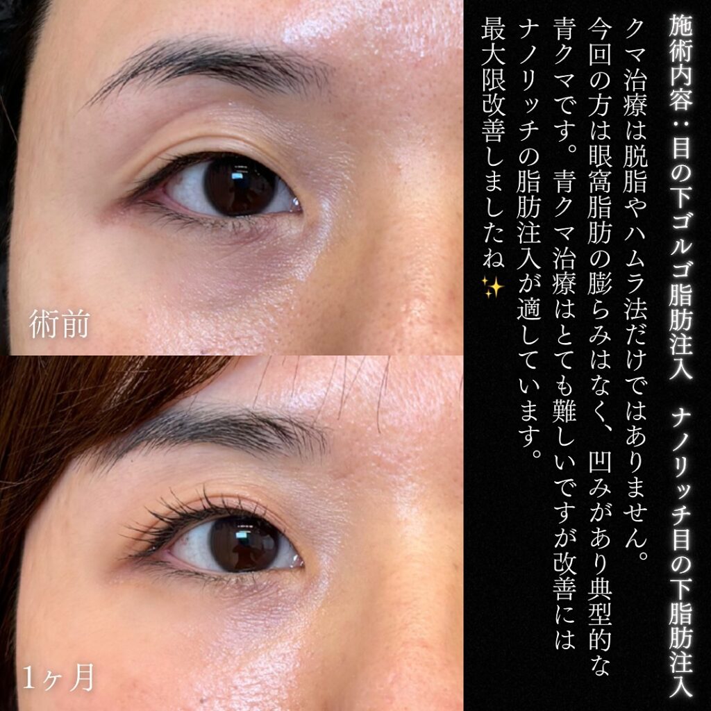 脂肪注入の症例写真 (8)