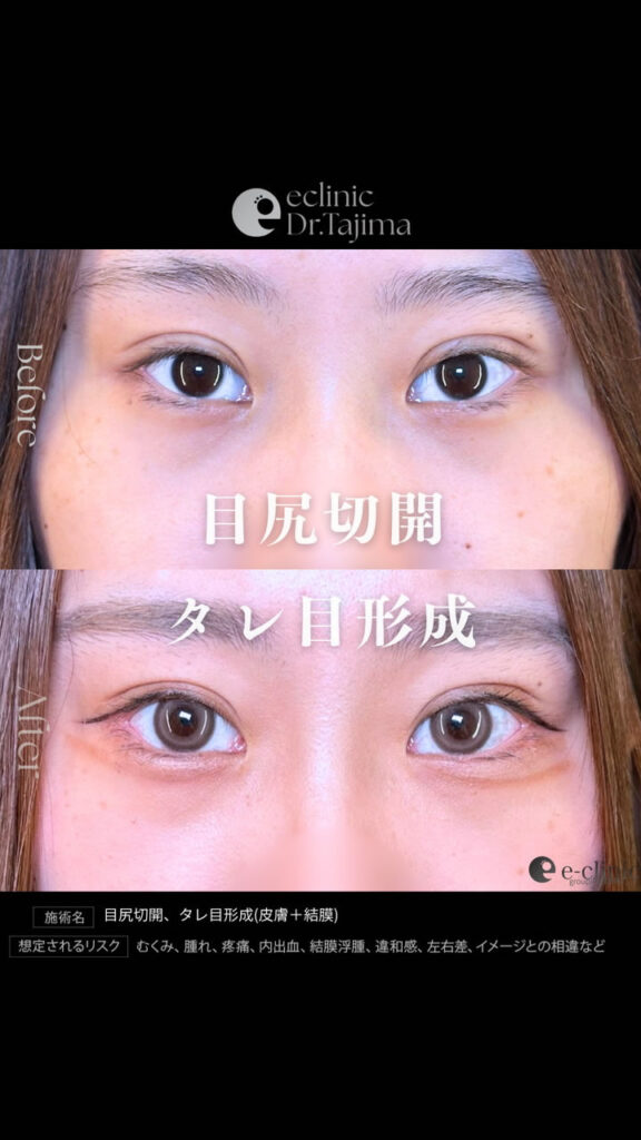 目尻切開とタレ目形成の症例写真