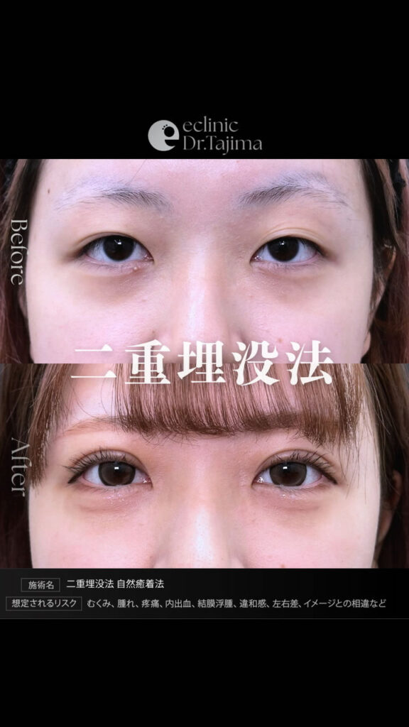 埋没法の症例写真