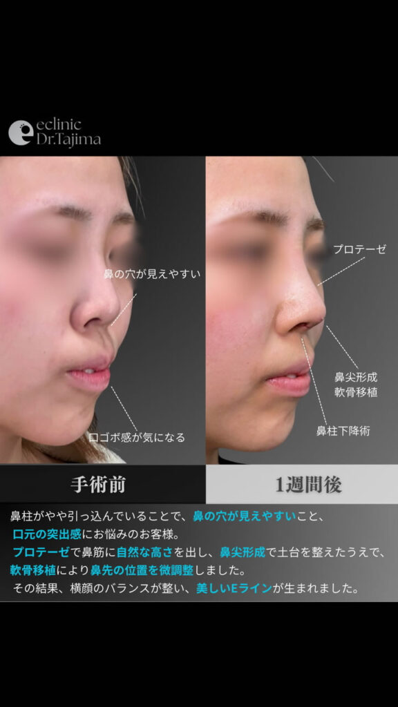 鼻のプロテーゼと鼻尖形成と軟骨移植と鼻柱下降の症例写真