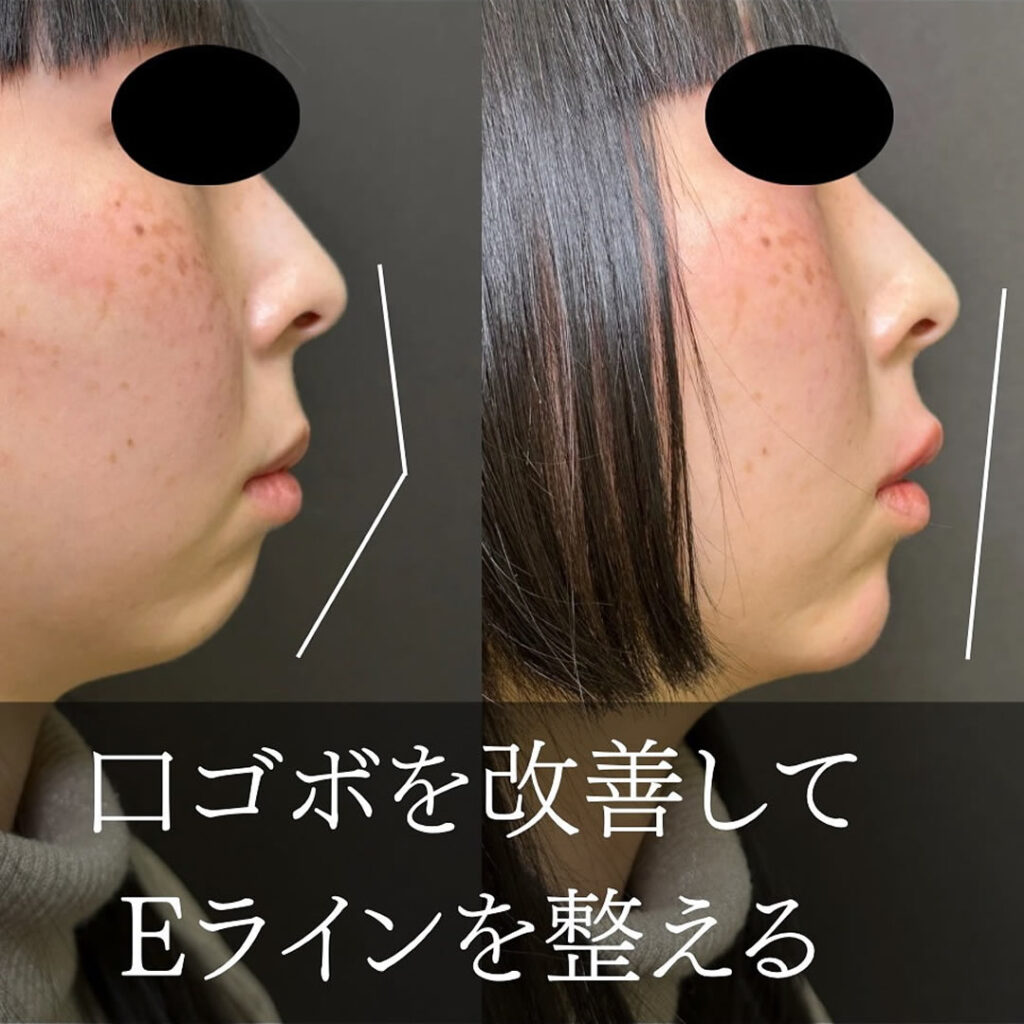 涙袋と唇と顎の口ゴボを改善してＥラインを整えたヒアルロン酸の症例写真