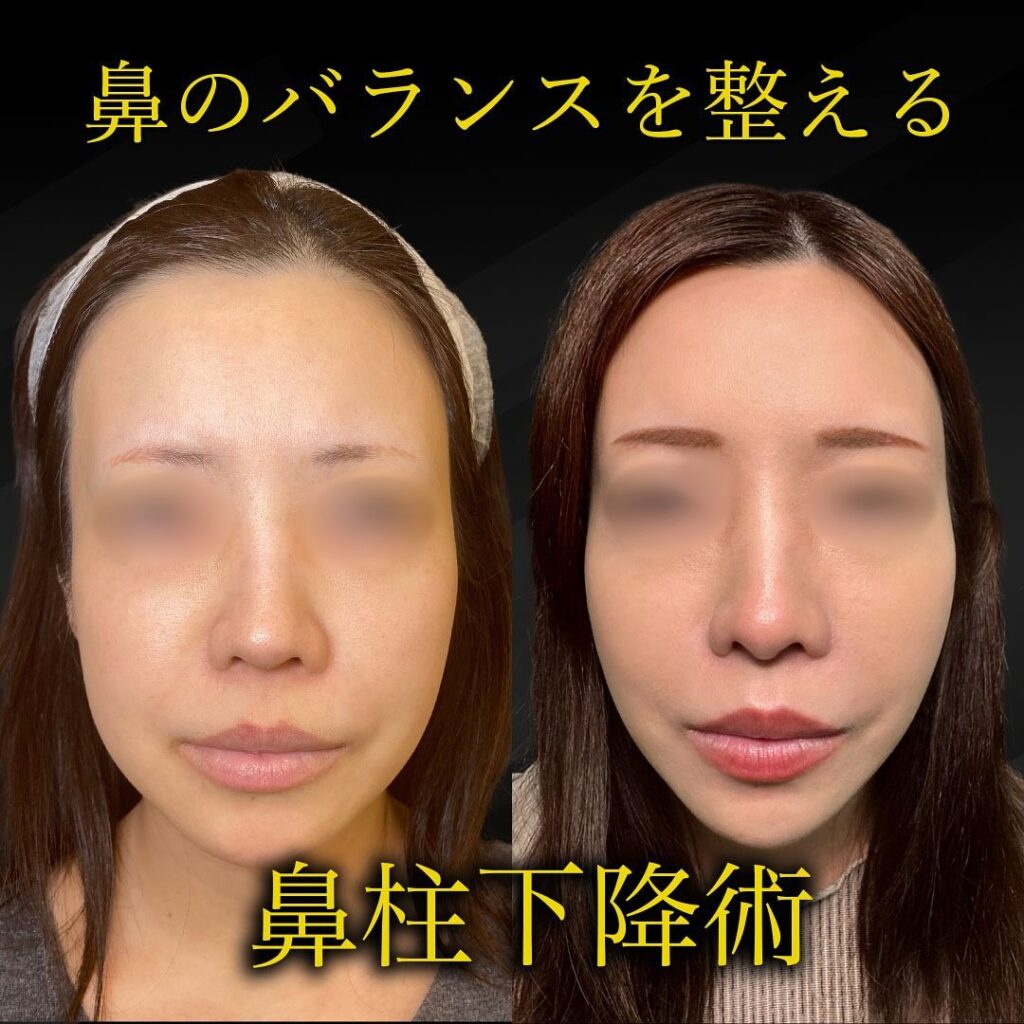 鼻柱下降術の症例写真 (1)