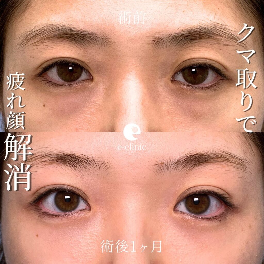 裏ハムラ法の術後1か月の症例写真