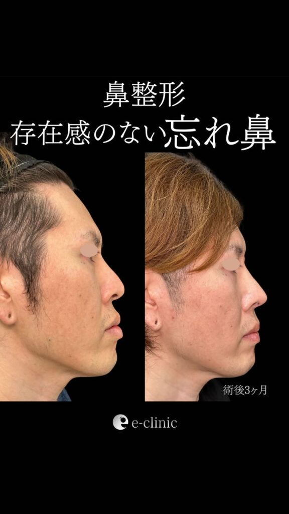 鼻尖形成と耳介軟骨移植と小鼻縮小の症例写真