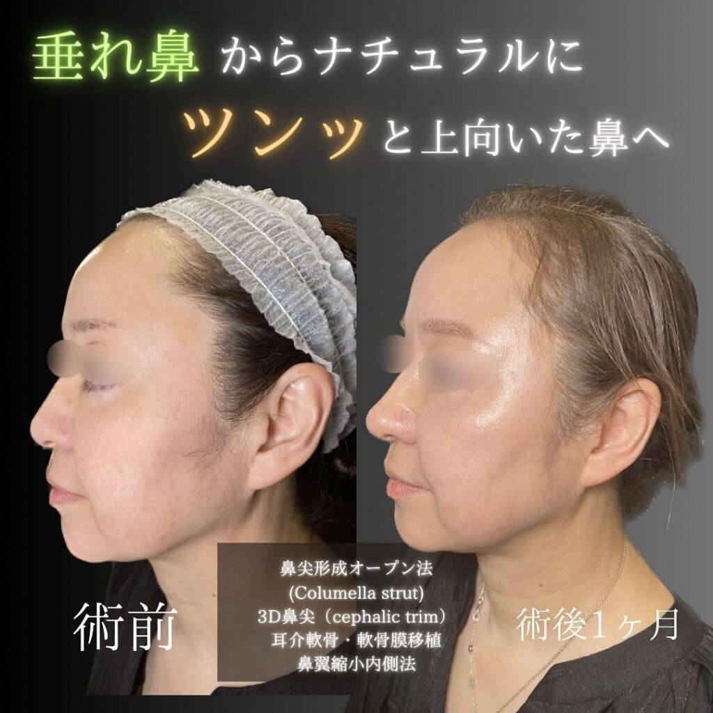 鼻尖形成オープン法と3D鼻尖形成と耳介軟骨・軟骨膜移植と小鼻縮小内側法の症例写真 (1)