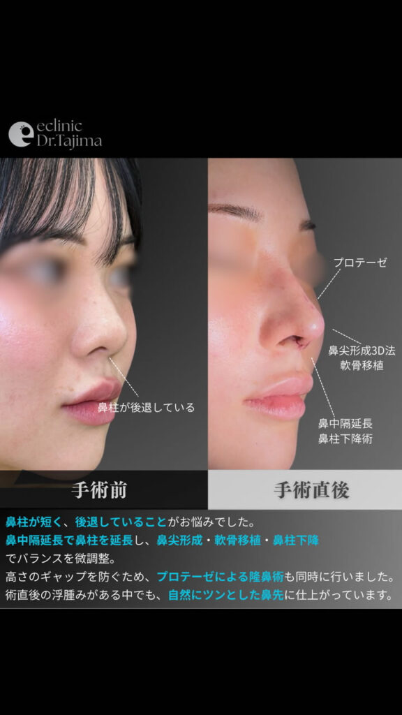 鼻のプロテーゼと鼻尖形成と軟骨移植と鼻中隔延長と鼻柱下降の症例写真