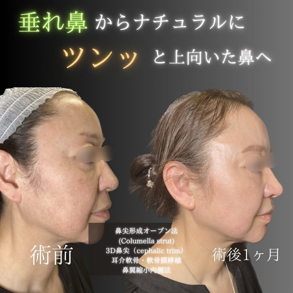 鼻尖形成オープン法と3D鼻尖形成と耳介軟骨・軟骨膜移植と小鼻縮小内側法の症例写真 (2)