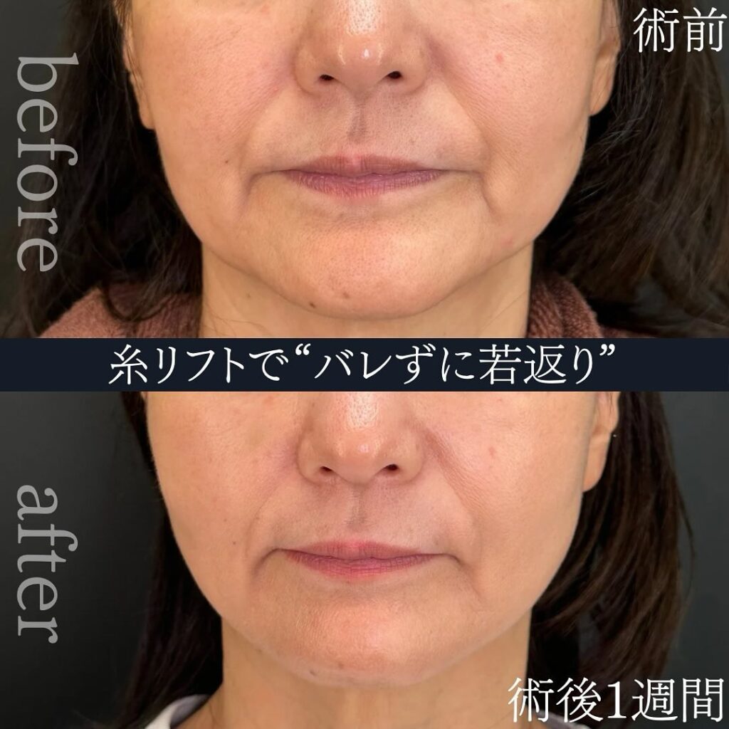 糸リフトでバレずに若返りをした症例写真