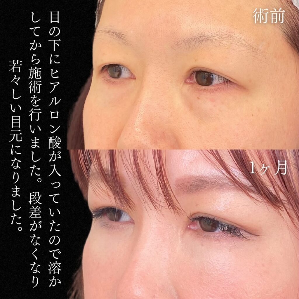 脱脂と脂肪注入の症例写真 (30)