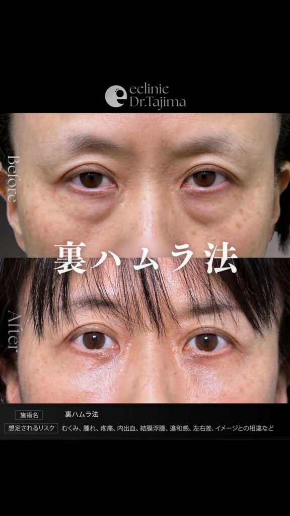 裏ハムラ法の症例写真1