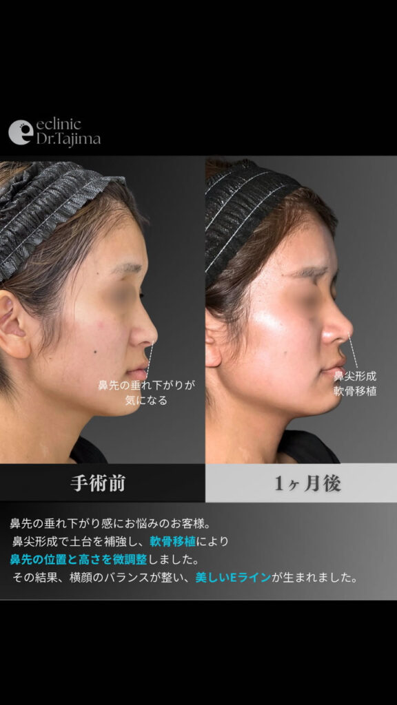 鼻尖形成と軟骨移植の症例写真