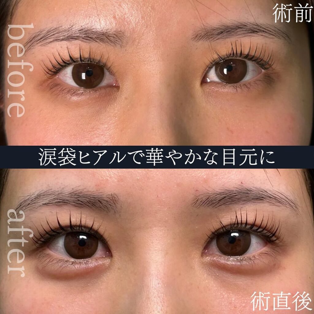涙袋のヒアルロン酸の症例写真
