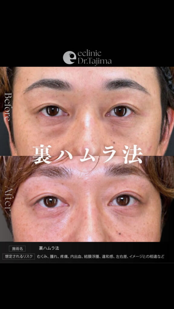 裏ハムラ法の症例写真