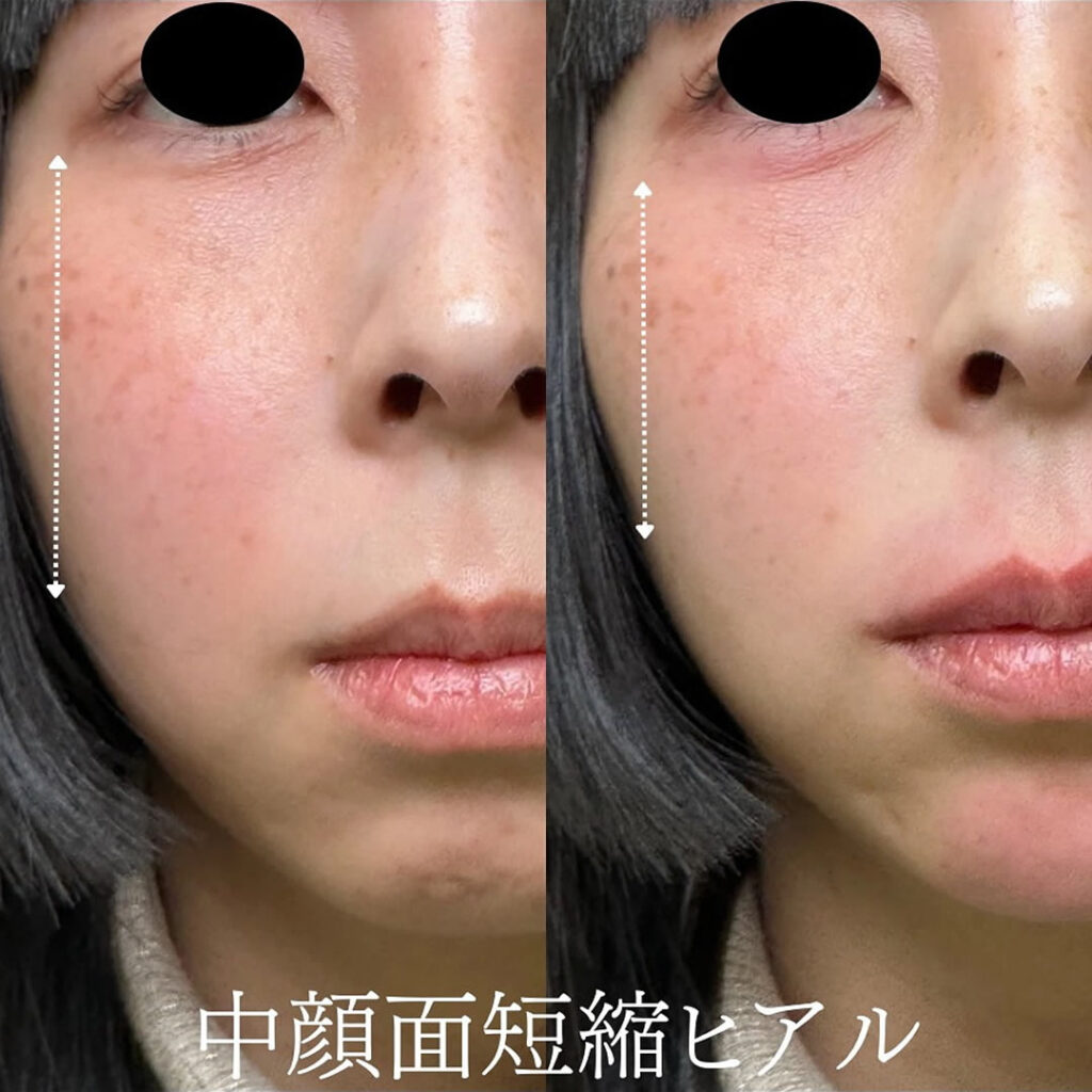 涙袋と唇と顎の中顔面を改善したヒアルロン酸の症例写真