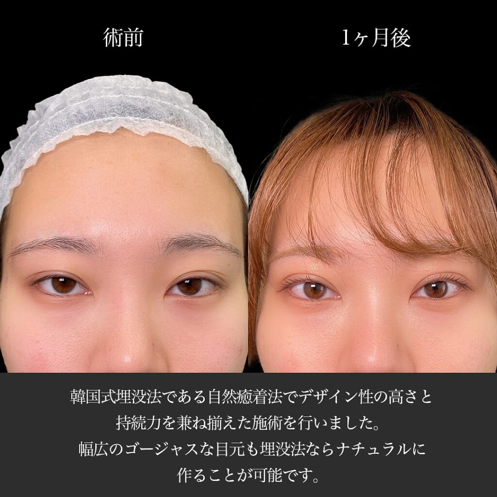 自然癒着法の症例写真 (10)