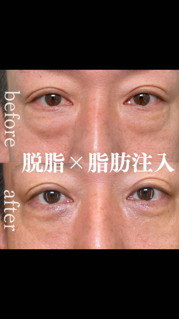 脱脂と脂肪注入の症例写真