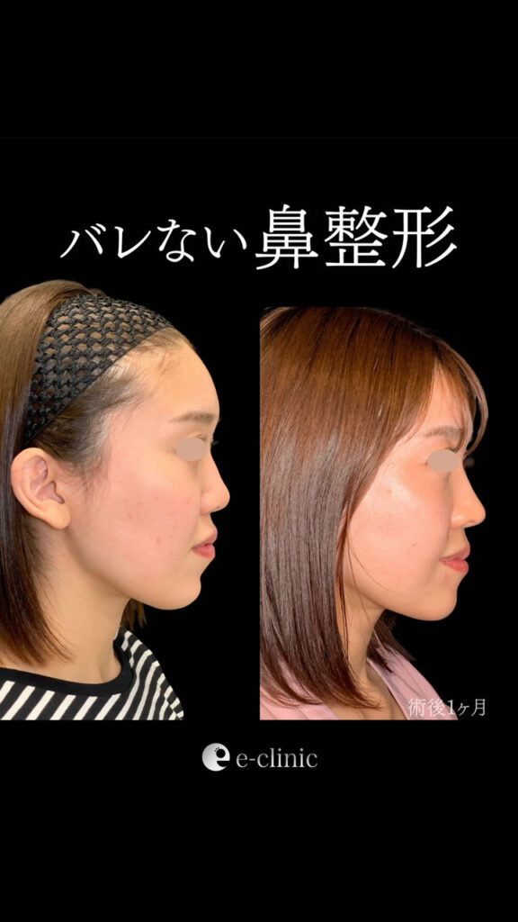 鼻尖形成と耳介軟骨移植と鼻のプロテーゼの症例写真