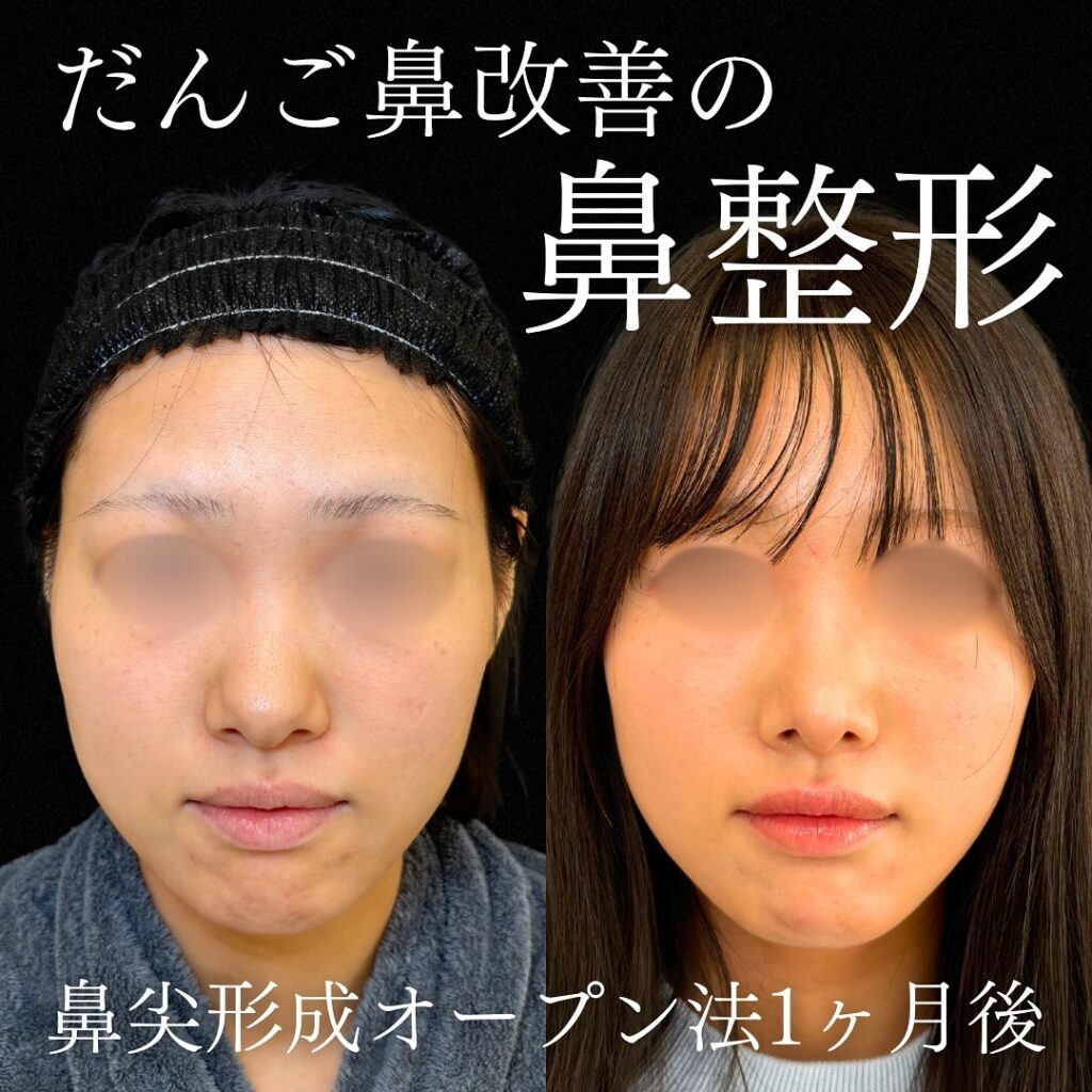 鼻尖形成と耳介軟骨移植の症例写真 (21)