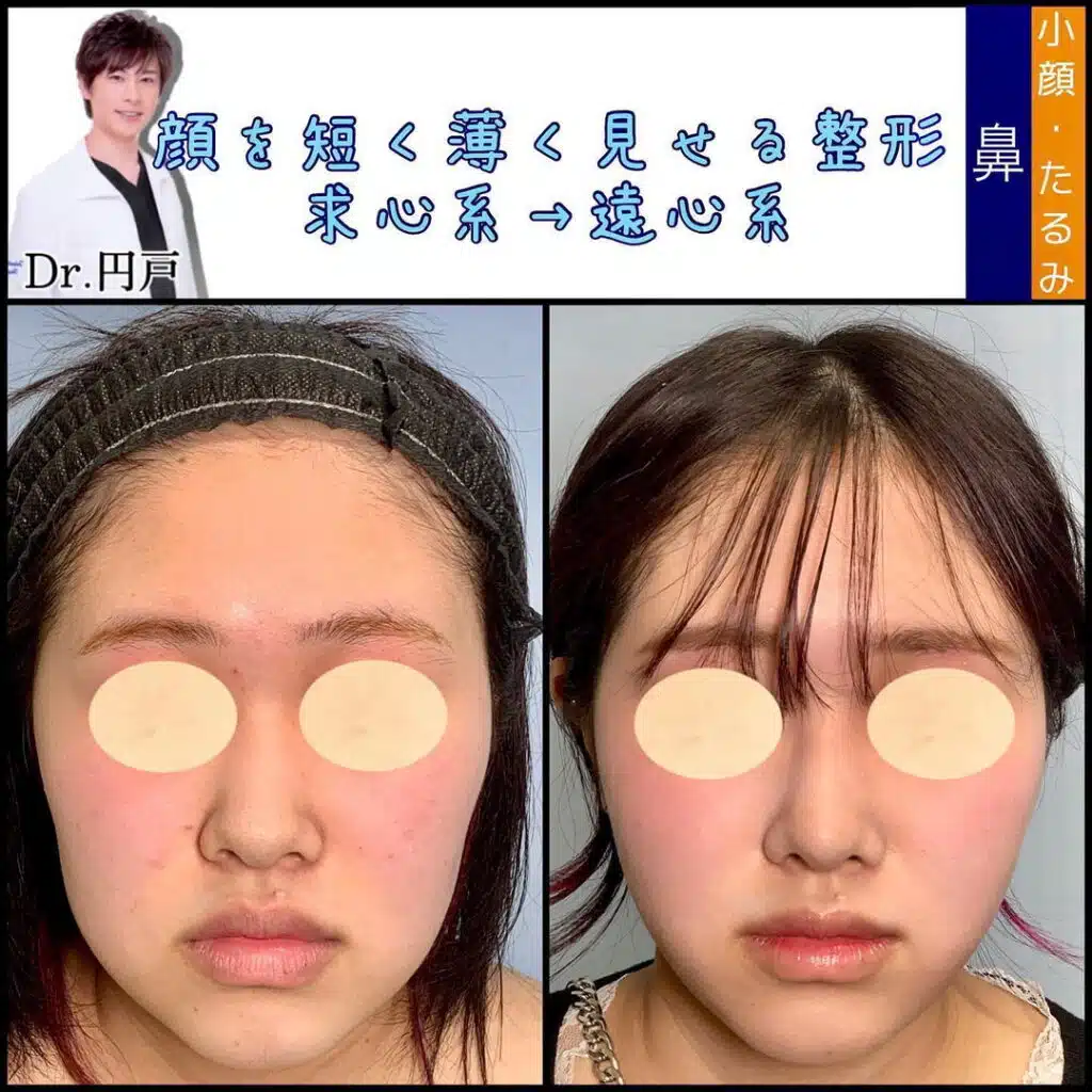 顔の脂肪吸引