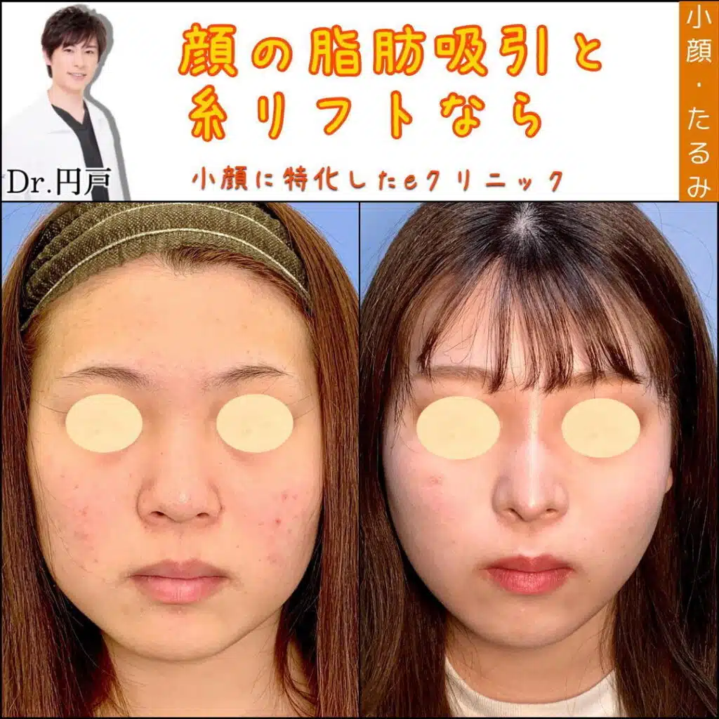 顔の脂肪吸引