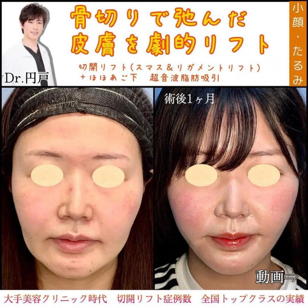 フェイスリフト
