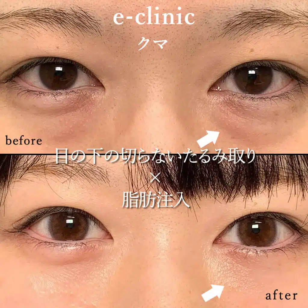 eclinic大阪梅田院の表ハムラの症例画像(1)