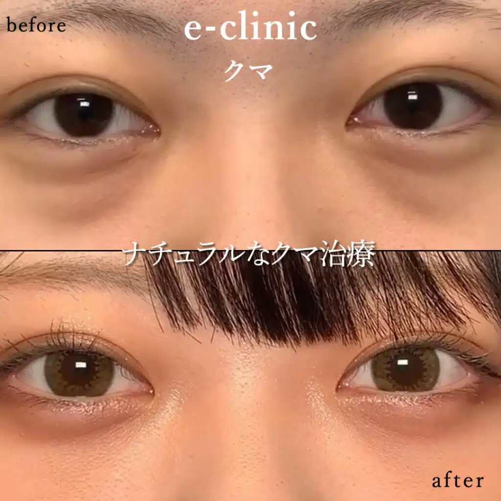 eclinic大阪梅田院の表ハムラの症例画像(2)