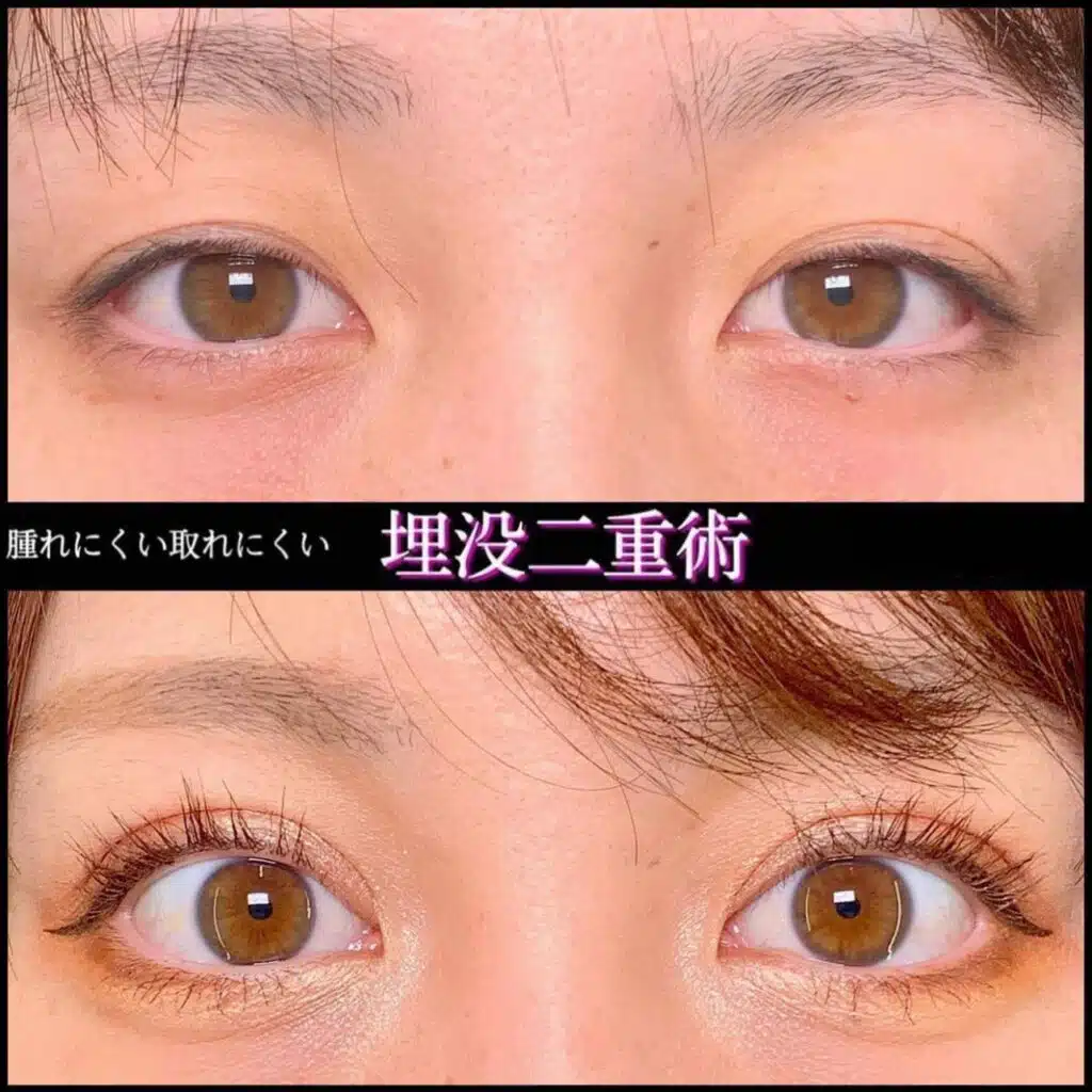 腫れにくい取れにくい 埋没二重術 岡山