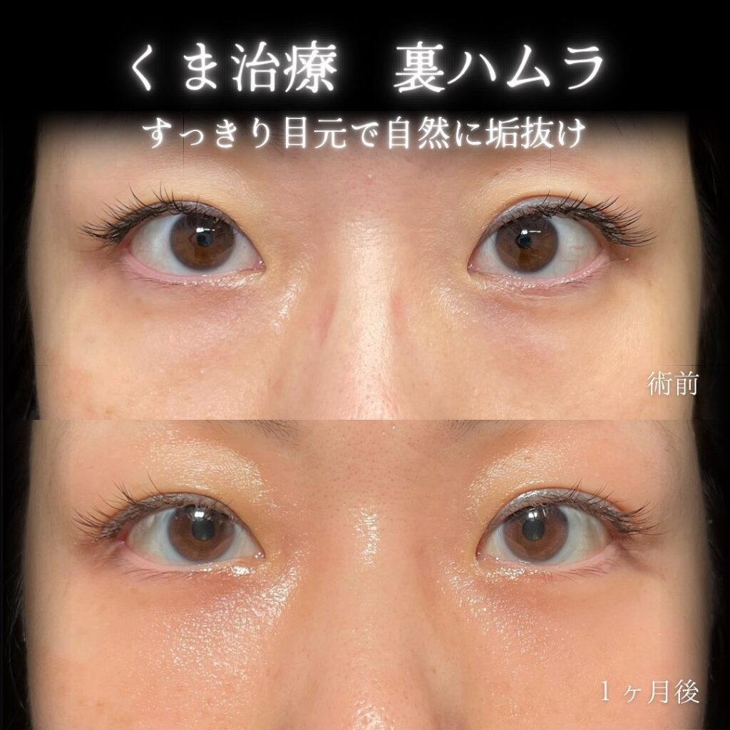 eclinic大阪梅田院の表ハムラの症例画像(4)