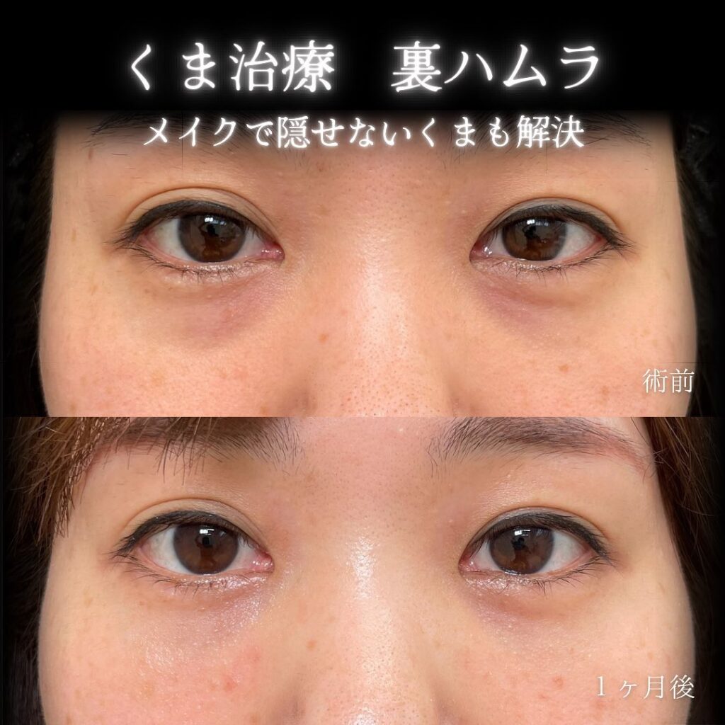 eclinic大阪梅田院の表ハムラの症例画像(5)