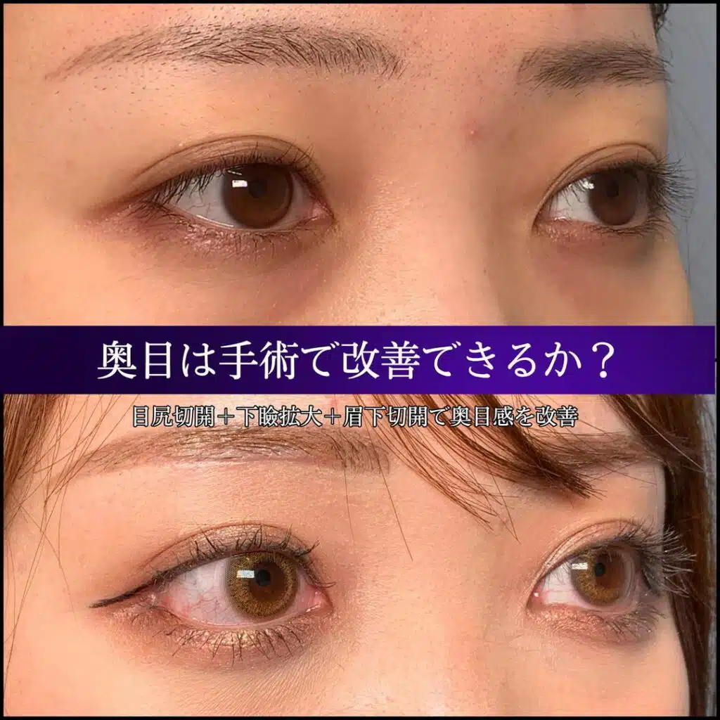 目尻切開 下瞼拡大 眉下切開 岡山