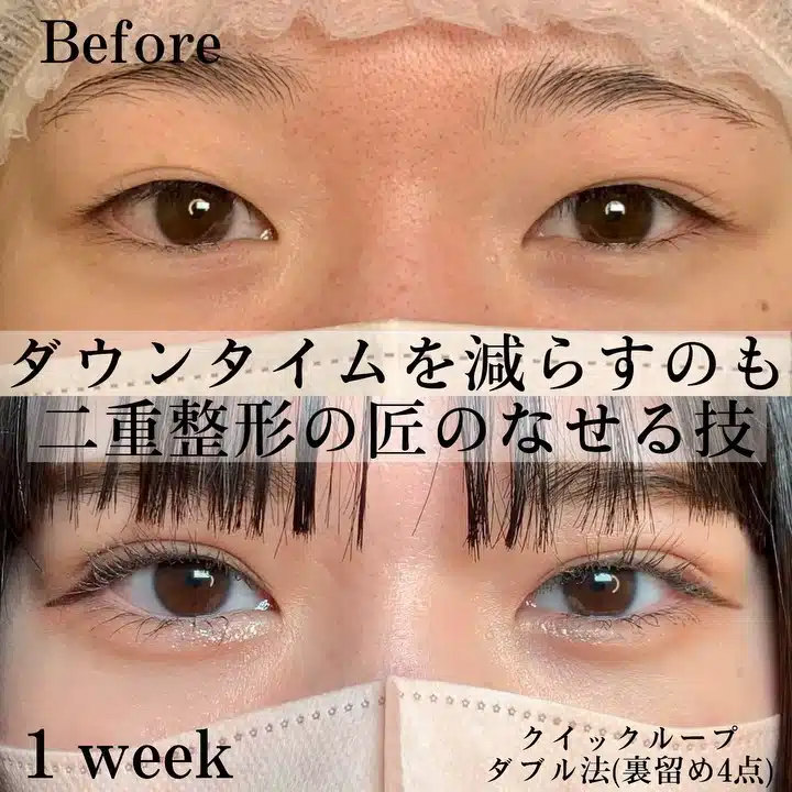 クイックループダブル法(裏留め4点) 岡山