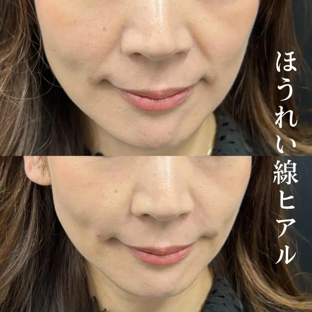 ほうれい線ヒアル　岡山