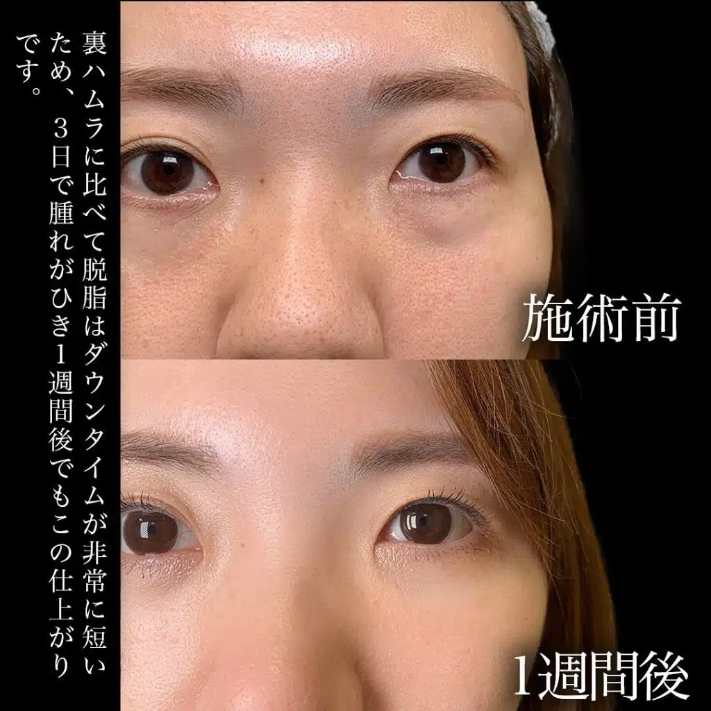 経結膜脱脂 岡山