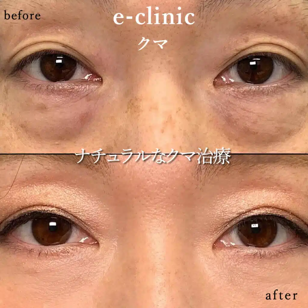 eclinic大阪梅田院の表ハムラの症例画像(3)