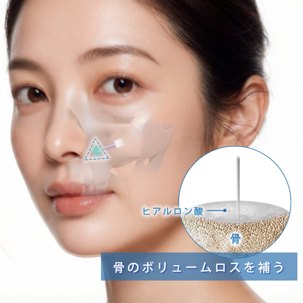 3点、ヒアル2点、ニュイ 岡山院のほうれい線ヒアルロン酸注射 | eクリニック岡山院【公式