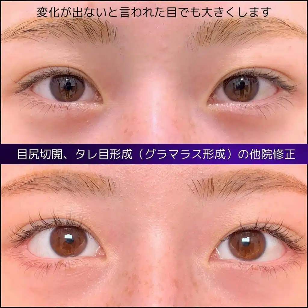 目尻切開 タレ目形成(グラマラス形成) 他院修正 岡山