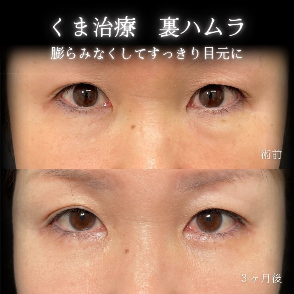 eclinic大阪梅田院の表ハムラの症例画像(6)