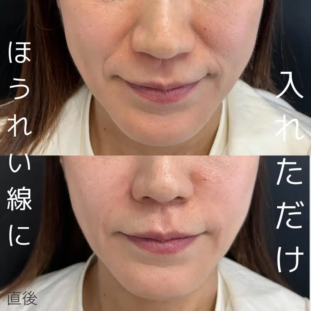 ほうれい線に入れただけ　岡山　　